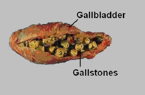 gallbladder surgery. Open gallbladder removal is